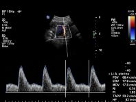 Doppler A uterina SSW 12