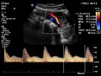 Zufluss zur Placenta Doppler A uterina SSW14
